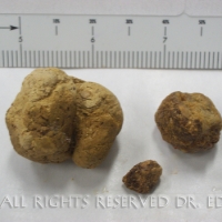 Gallstones I Passed 10/21/09