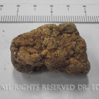 Gallstones I Passed 4/14/09