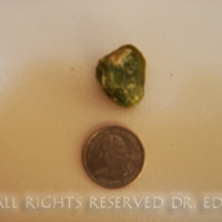 Gallstones I Passed 5-12-08