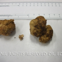 Gallstones I Passed 5/19/09