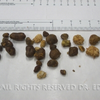 Gallstones I Passed 6/29/09