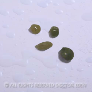 Gallstones