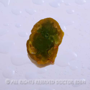 Gallstones